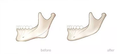 下颌肥大手术效果图