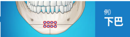 下巴用钛钉固定示意图