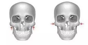 颧骨手术示意图
