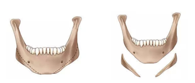 下颌角手术示意图