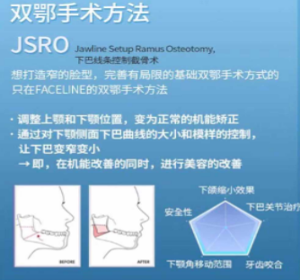 韩国菲斯莱茵双颚手术方法