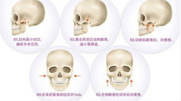 颧骨整形手术示意图