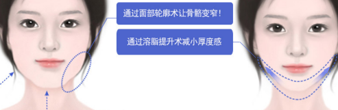 韩国菲斯莱茵抗衰老童颜轮廓手术所改善问题示意图