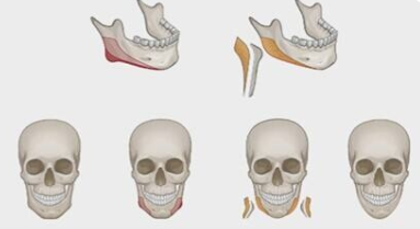下颌角手术示意图