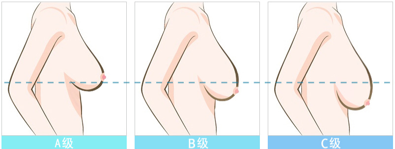 胸部下垂分级示意图