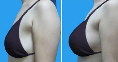 胸部下垂做乳房上提案例效果